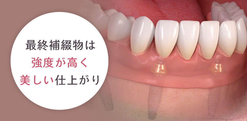 人工歯(ブリッジ)の装着
